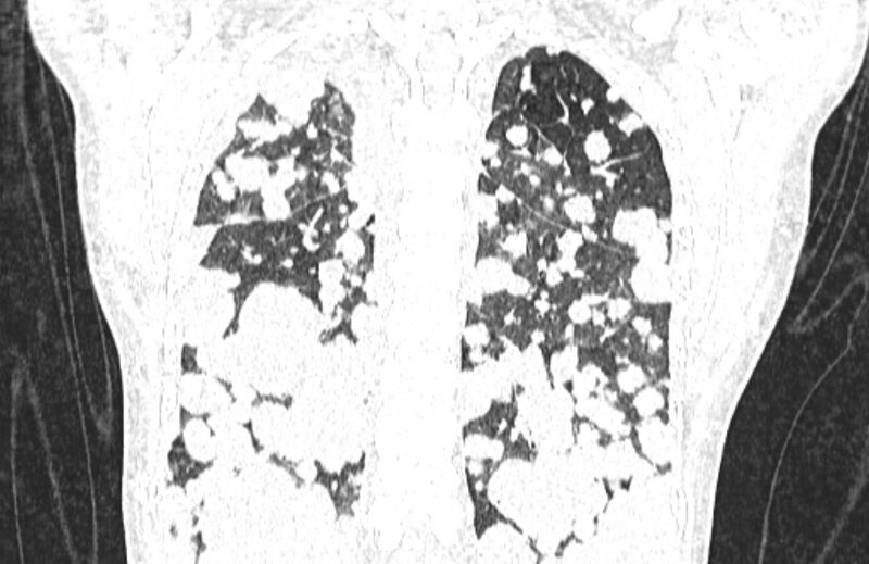 File:Cannonball metastases from breast cancer (Radiopaedia 91024-108569 Coronal lung window 112).jpg
