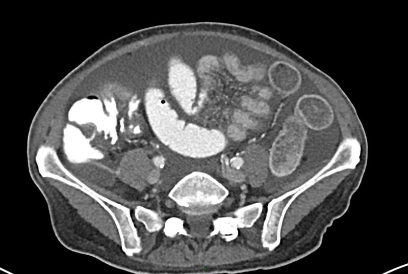 File:Carcinoid mesenteric tumor complicated by chylous ascites (Radiopaedia 76312-87953 A 52).jpg