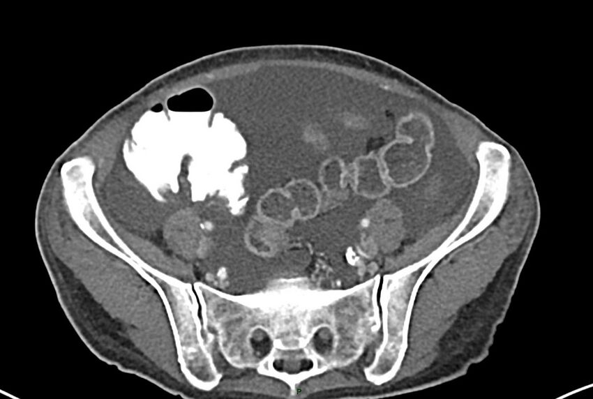 Carcinoid mesenteric tumor complicated by chylous ascites (Radiopaedia 76312-87953 A 57).jpg
