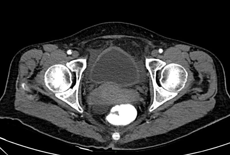 File:Carcinoid mesenteric tumor complicated by chylous ascites (Radiopaedia 76312-88926 A 73).jpg