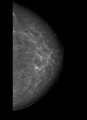 Cardiac pacemaker (mammography) (Radiopaedia 72298-82831 L CC 1).PNG