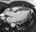 Cardiac sarcoidosis (Radiopaedia 39811-42243 LVOT cine images 10).jpg