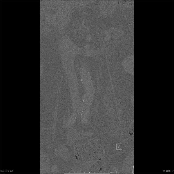 File:Cardiac trauma (Radiopaedia 32874-33858 Coronal bone window 17).jpg