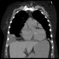 Cardiogenic pulmonary edema (Radiopaedia 29213-29609 Coronal non-contrast 14).jpg