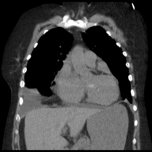 File:Cardiogenic pulmonary edema (Radiopaedia 29213-29609 Coronal non-contrast 14).jpg