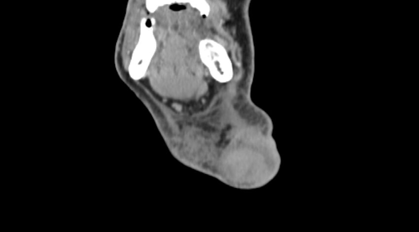 Carotid artery pseudoaneurysm (Radiopaedia 84030-99259 D 2).jpg