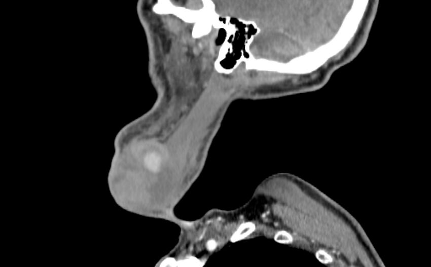 Carotid artery pseudoaneurysm (Radiopaedia 84030-99259 E 58).jpg