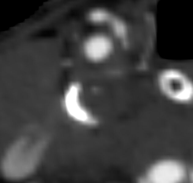 File:Carotid near-occlusion (Radiopaedia 85304-100887 M 45).jpg