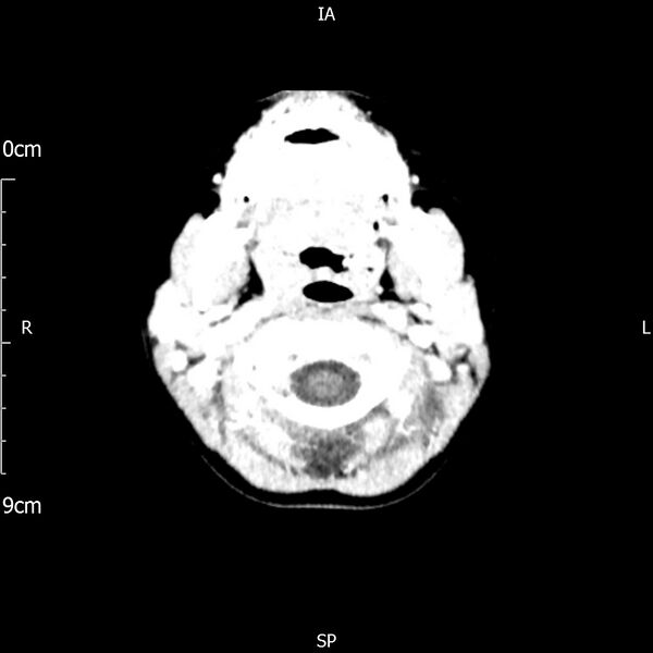 File:Cavernous sinus thrombosis (Radiopaedia 79414-92510 Axial Brain 34).jpg