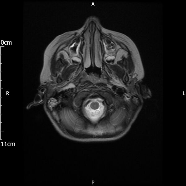 File:Cavernous sinus thrombosis (Radiopaedia 79414-92512 Axial T2 3).jpg