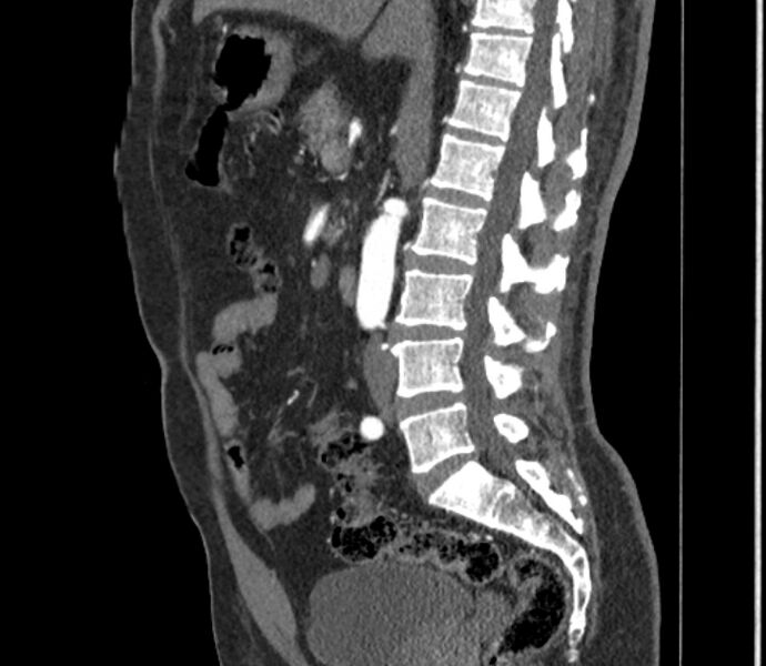 File:Celiac artery dissection (Radiopaedia 52194-58080 B 48).jpg