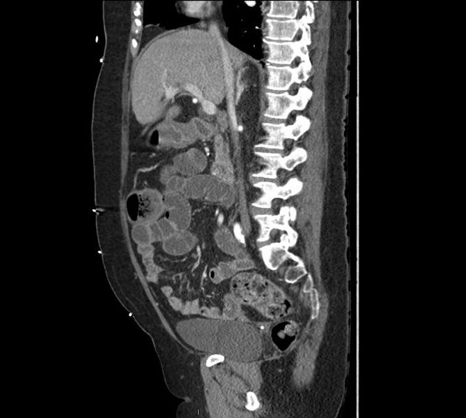 File:Celiac artery severe stenosis and dissection (Radiopaedia 44128-47842 A 25).jpg