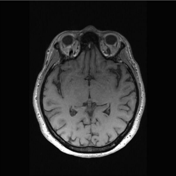 File:Central base of skull meningioma (Radiopaedia 53531-59549 Axial T1 30).jpg