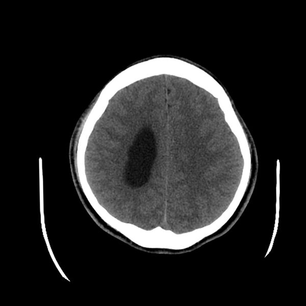 File:Central neurocytoma (Radiopaedia 79320-92379 Axial non-contrast 33).jpg