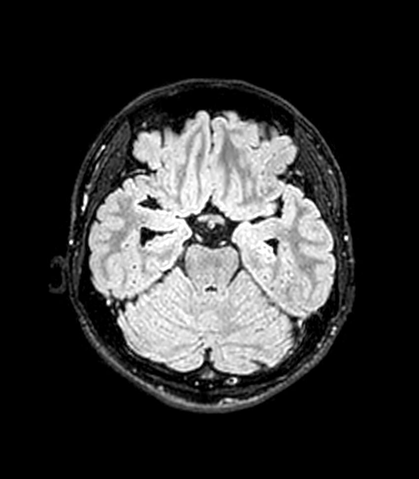 Central neurocytoma (Radiopaedia 79320-92380 Axial FLAIR 202).jpg