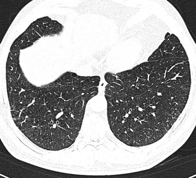 File:Centrilobular pulmonary emphysema (Radiopaedia 26808-26971 Axial lung window 30).jpg