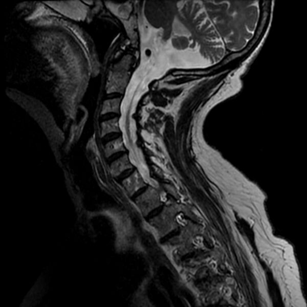 File:Cerebellar ataxia with neuropathy and vestibular areflexia syndrome (CANVAS) (Radiopaedia 74283-85159 Sagittal T2 7).jpg