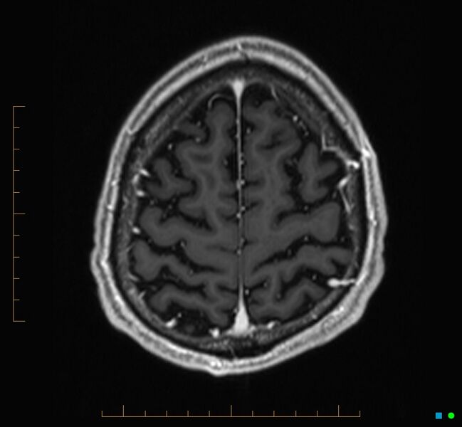 File:Cerebellar gangliocytoma (Radiopaedia 65377-74422 Axial T1 C+ 122).jpg