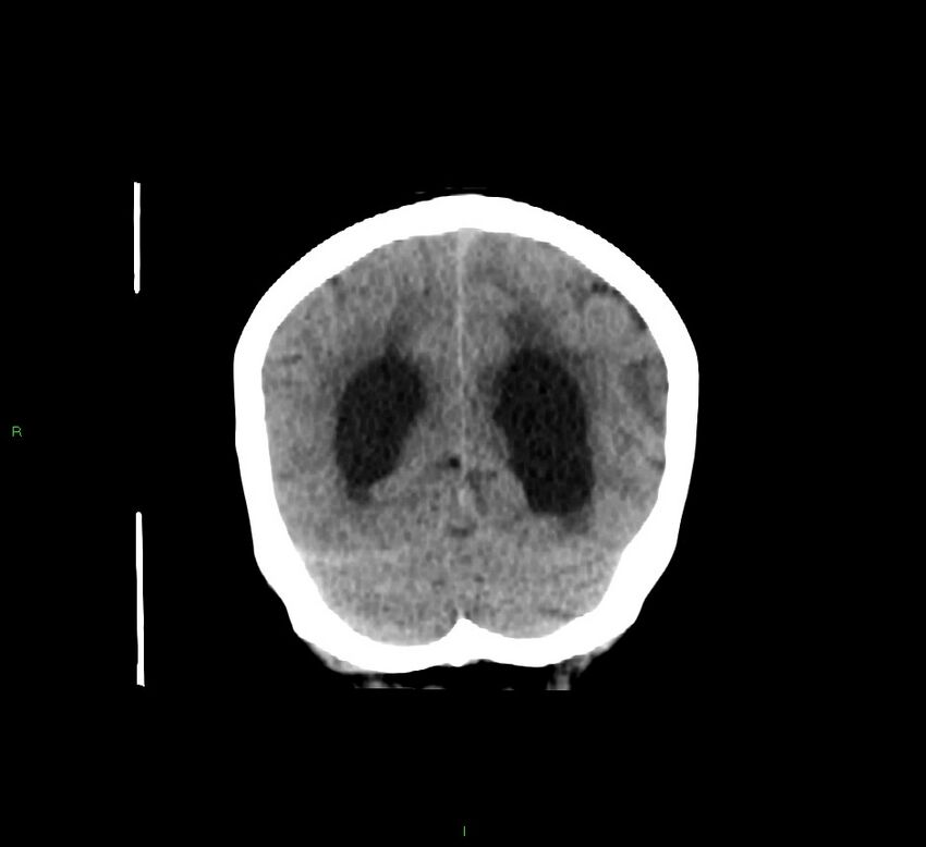 Cerebellar hemorrhage (Radiopaedia 58793-66027 Coronal non-contrast 20).jpg