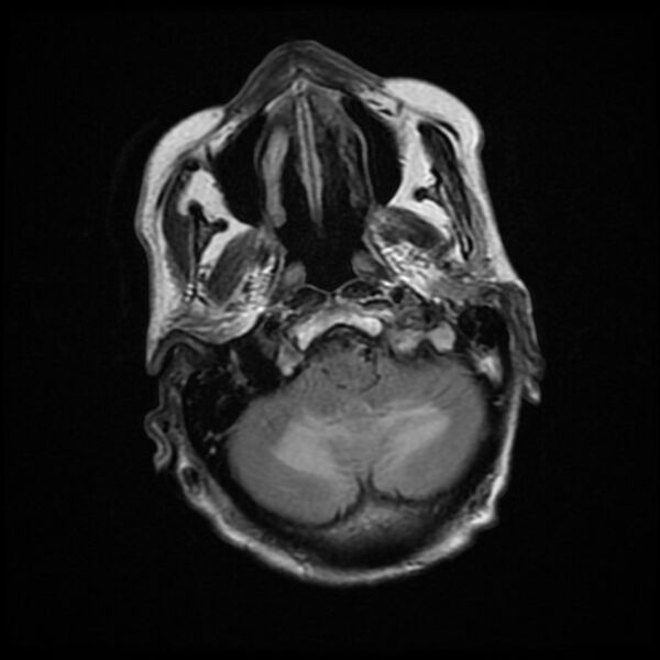 File:Cerebellar metastasis - lung tumor (Radiopaedia 69317-79147 Axial FLAIR 18).jpg