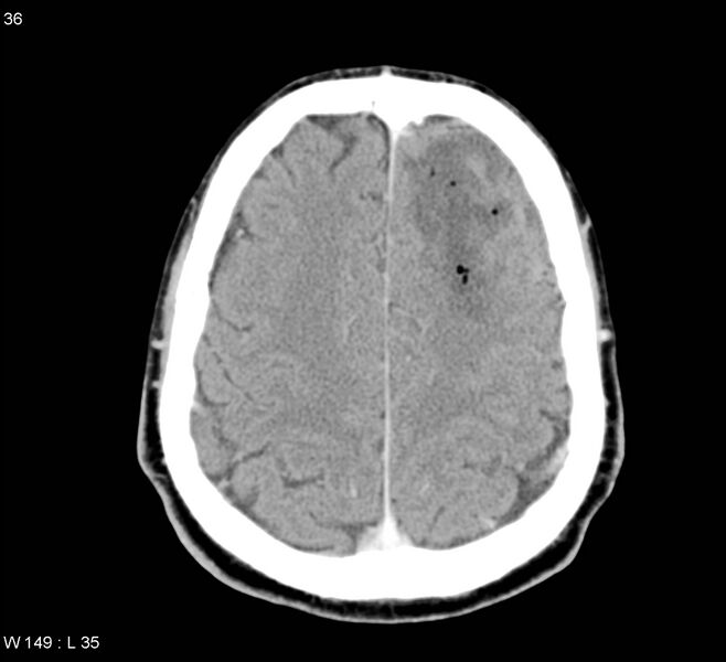 File:Cerebral abscess (Radiopaedia 5150-6933 Axial C+ delayed 5).jpg