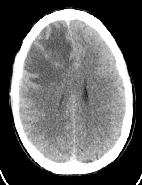 File:Cerebral abscess (Radiopaedia 60342-68008 Axial non-contrast 34).png