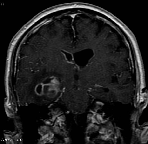 File:Cerebral abscess and ventriculitis (Radiopaedia 5024-6885 Coronal T1 C+ 3).jpg