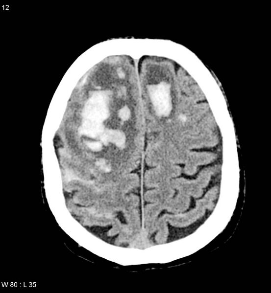 File:Cerebral abscesses secondary to contusions (Radiopaedia 5201-22213 Axial non-contrast 5).jpg