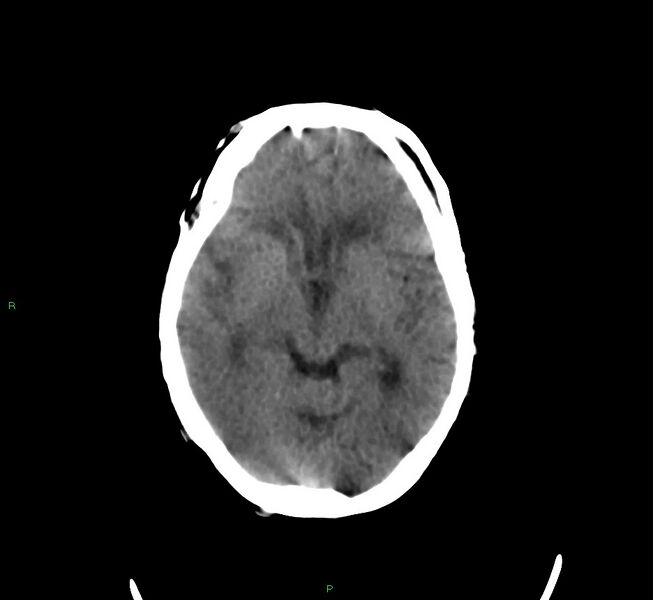 File:Cerebral amyloid angiopathy-associated lobar intracerebral hemorrhage (Radiopaedia 58377-65514 Axial non-contrast 28).jpg
