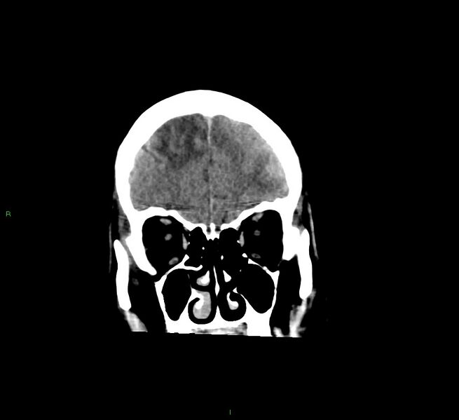 File:Cerebral amyloid angiopathy-associated lobar intracerebral hemorrhage (Radiopaedia 58529-65681 Coronal non-contrast 53).jpg