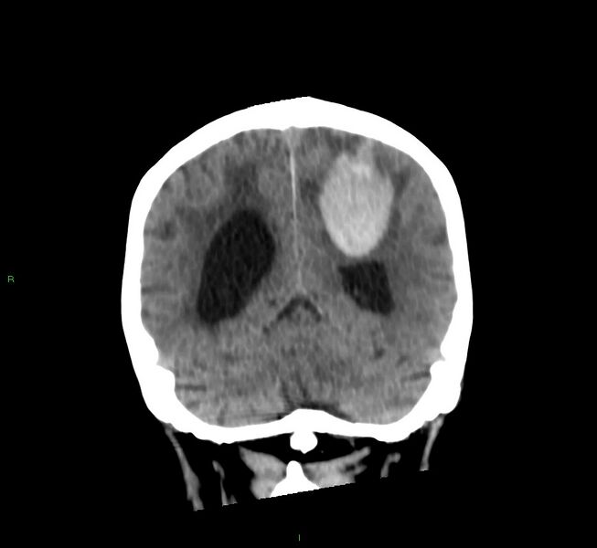 File:Cerebral amyloid angiopathy-associated lobar intracerebral hemorrhage (Radiopaedia 58530-65688 Coronal non-contrast 22).jpg