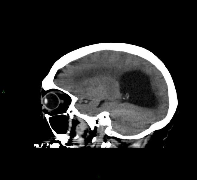 File:Cerebral amyloid angiopathy-associated lobar intracerebral hemorrhage (Radiopaedia 58560-65723 C 36).jpg