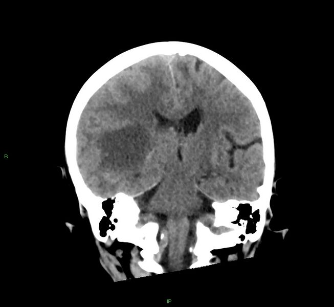 File:Cerebral amyloid angiopathy-associated lobar intracerebral hemorrhage (Radiopaedia 58563-65727 Coronal non-contrast 32).jpg