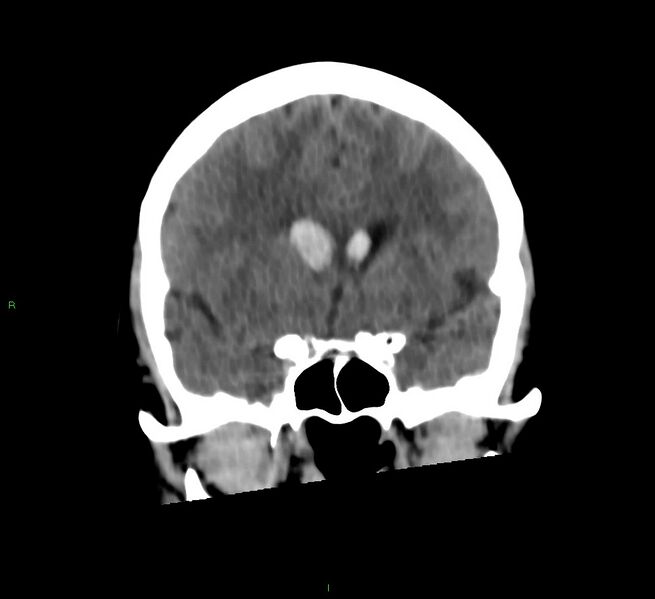 File:Cerebral amyloid angiopathy-associated lobar intracerebral hemorrhage (Radiopaedia 58566-65730 Coronal non-contrast 46).jpg