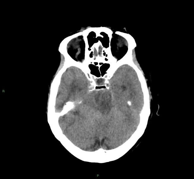 File:Cerebral amyloid angiopathy-associated lobar intracerebral hemorrhage (Radiopaedia 58751-65972 Axial non-contrast 34).jpg