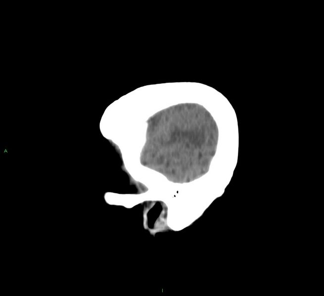 File:Cerebral amyloid angiopathy-associated lobar intracerebral hemorrhage (Radiopaedia 58751-65972 C 8).jpg