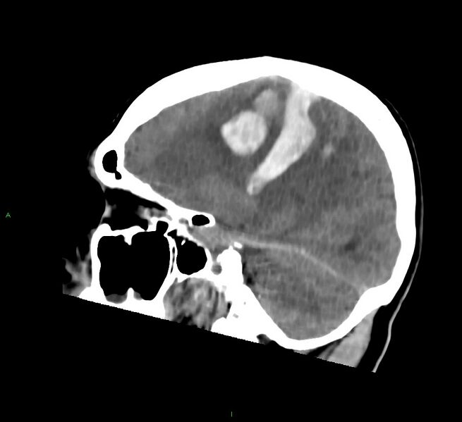 File:Cerebral amyloid angiopathy-associated lobar intracerebral hemorrhage (Radiopaedia 58756-65977 C 24).jpg