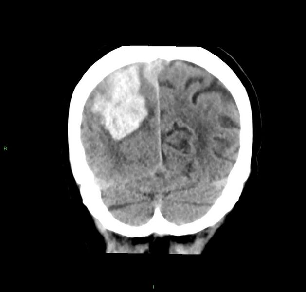 File:Cerebral amyloid angiopathy-associated lobar intracerebral hemorrhage (Radiopaedia 59356-66716 Coronal non-contrast 16).jpg