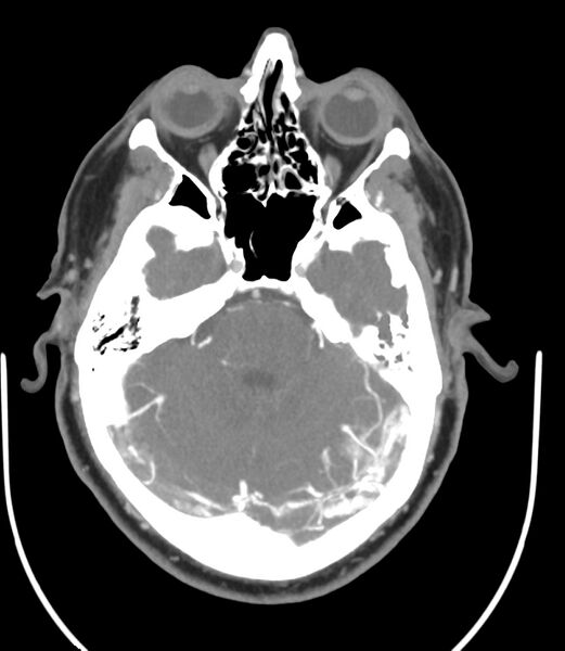 File:Cerebral dural venous sinus thrombosis (Radiopaedia 86514-102576 A 40).jpg