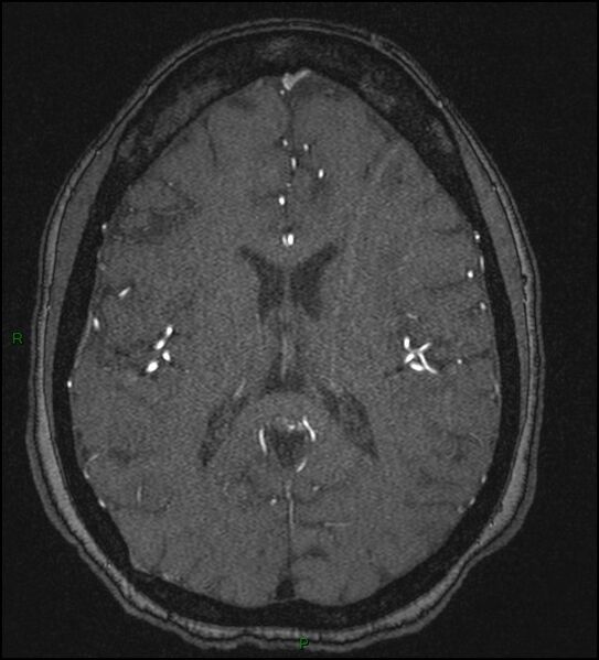 File:Cerebral fat embolism (Radiopaedia 35022-36525 Axial TOF 123).jpg