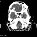 Cerebral hemorrhagic contusion with subdural and subarachnoid hemorrhage (Radiopaedia 10680-19197 Axial non-contrast 2).jpg