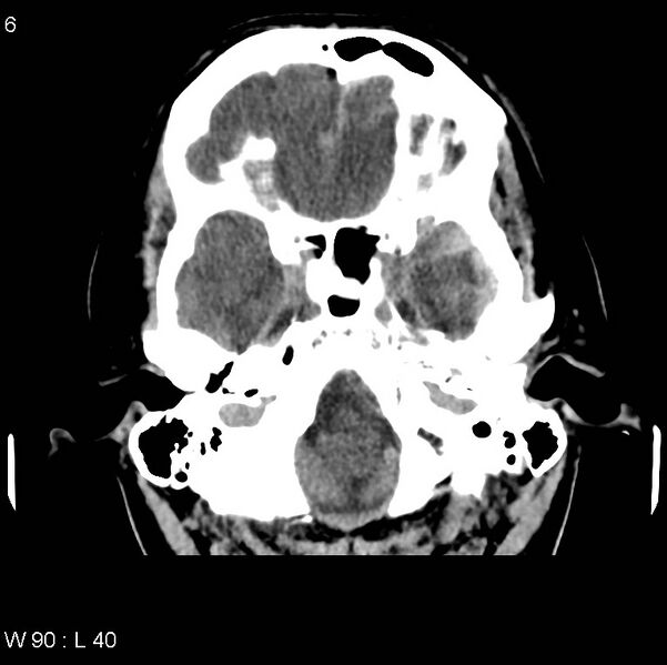 File:Cerebral hemorrhagic contusion with subdural and subarachnoid hemorrhage (Radiopaedia 10680-19197 Axial non-contrast 2).jpg