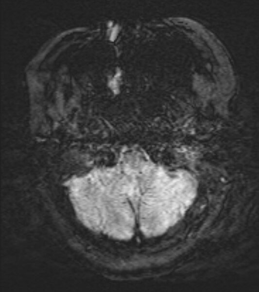 File:Cerebral venous infarct (Radiopaedia 53627-59685 Axial SWI 5).jpg