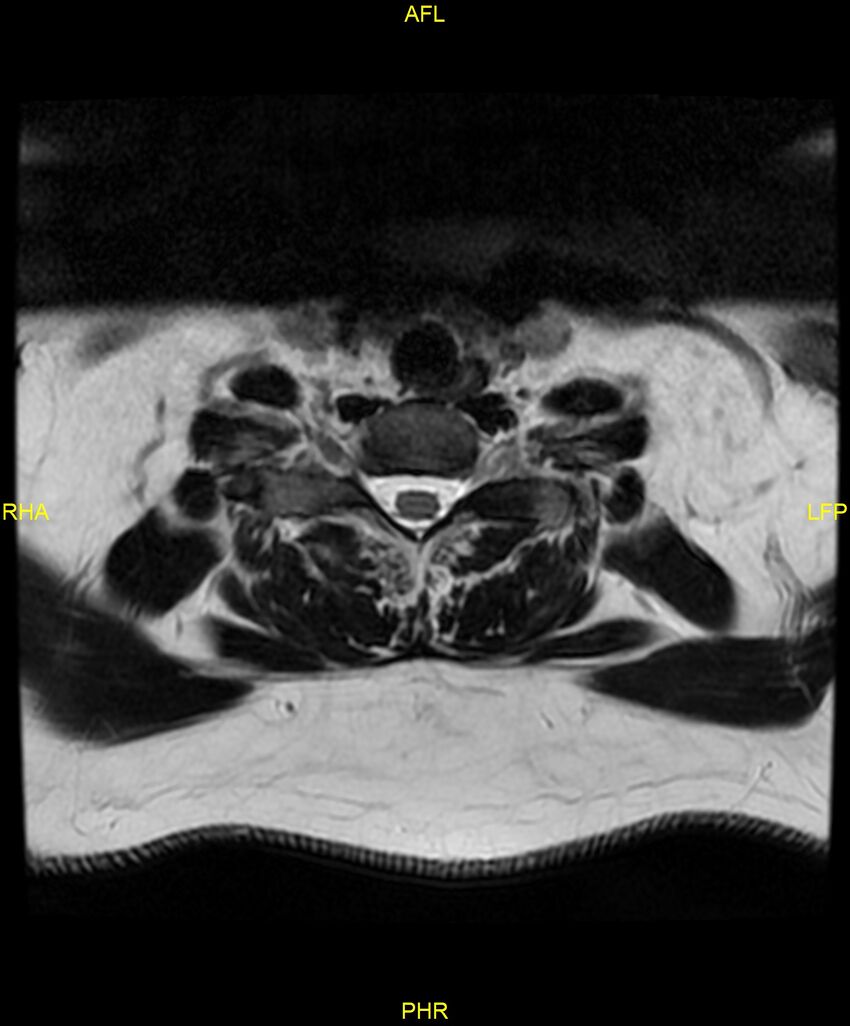 Cervical disc protrusion (Radiopaedia 87147-103415 Axial T2 66).jpg