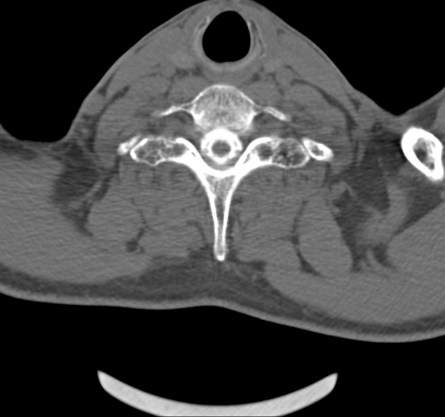 File:Cervical dural CSF leak on MRI and CT treated by blood patch (Radiopaedia 49748-54996 B 37).png