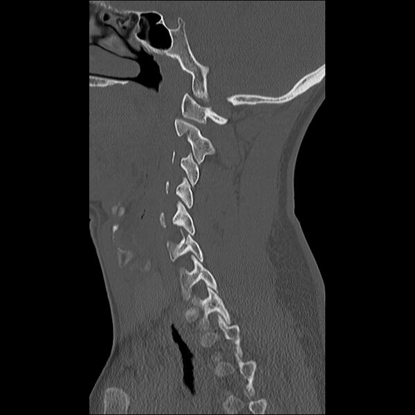 File:Cervical facet fracture and anterior discoligamentous injury (Radiopaedia 32139-33083 Sagittal bone window 26).jpg