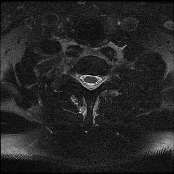 File:Cervical fracture and dislocation with locked facet (Radiopaedia 31837-32781 Axial T2 fat sat 11).jpg