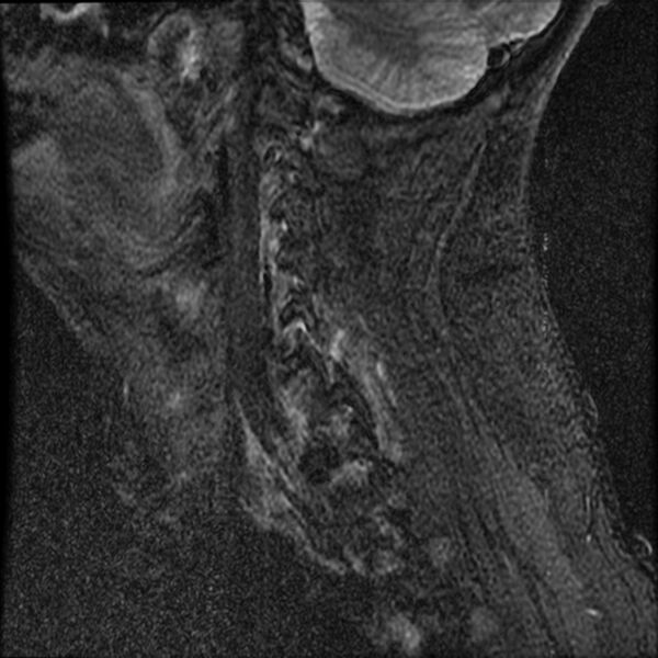 File:Cervical fracture and dislocation with locked facet (Radiopaedia 31837-32781 Sagittal STIR 3).jpg