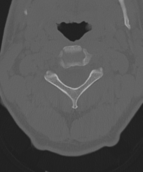File:Cervical intercalary bone (Radiopaedia 35211-36748 Axial bone window 22).png