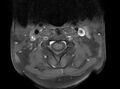 Cervical schwannoma (Radiopaedia 72399-82934 Axial T1 C+ fat sat 2).jpg